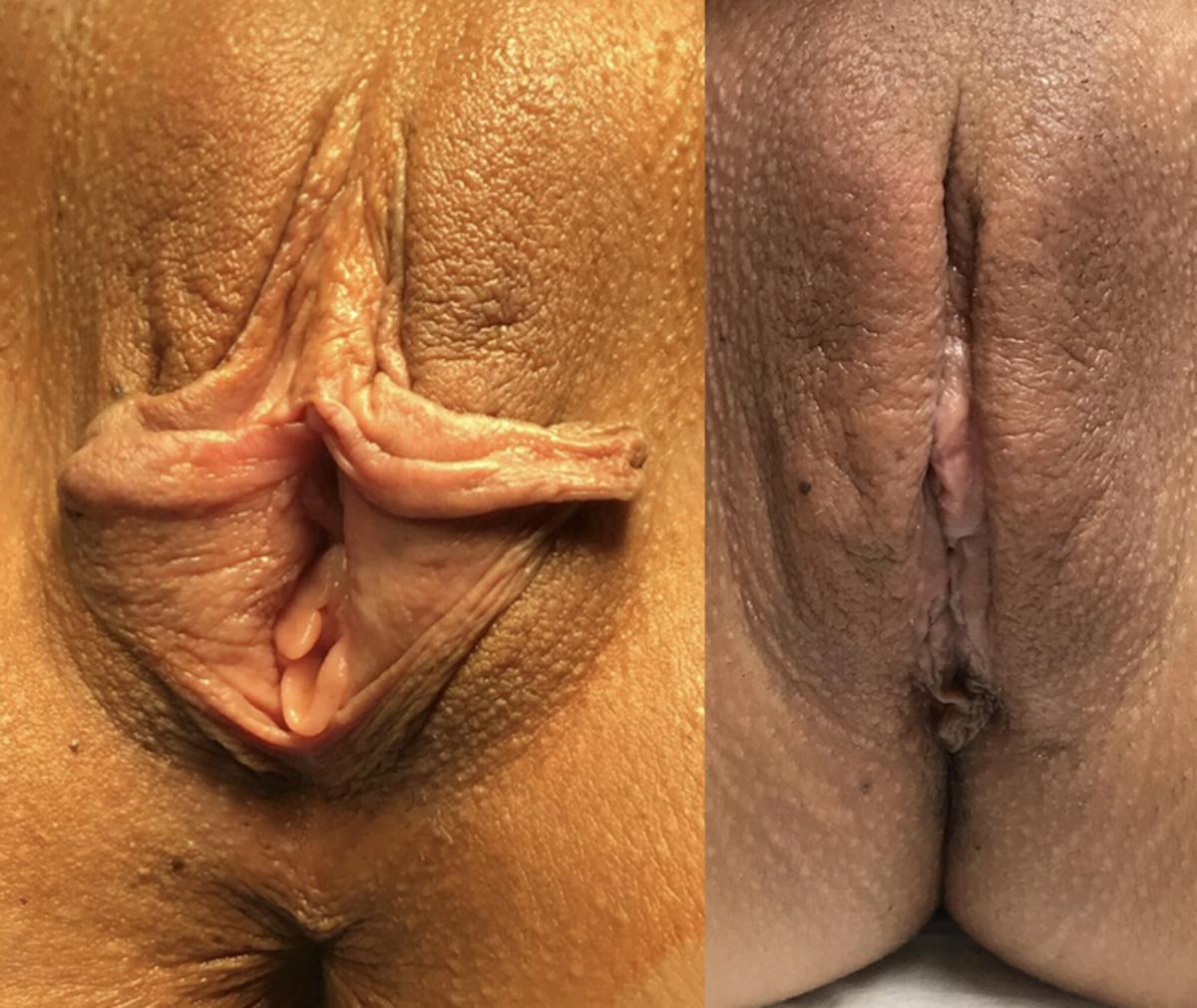 Labiaplasty Before & After Gallery - Patient 162739 - Image 1