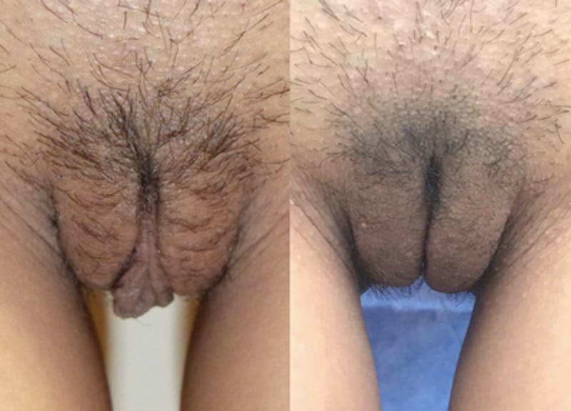 Labiaplasty Before & After Gallery - Patient 153816 - Image 1