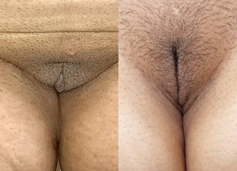 Labiaplasty Before & After Gallery - Patient 970140 - Image 1