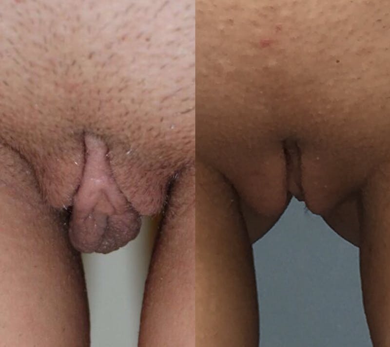 Labiaplasty Before & After Gallery - Patient 317445 - Image 1