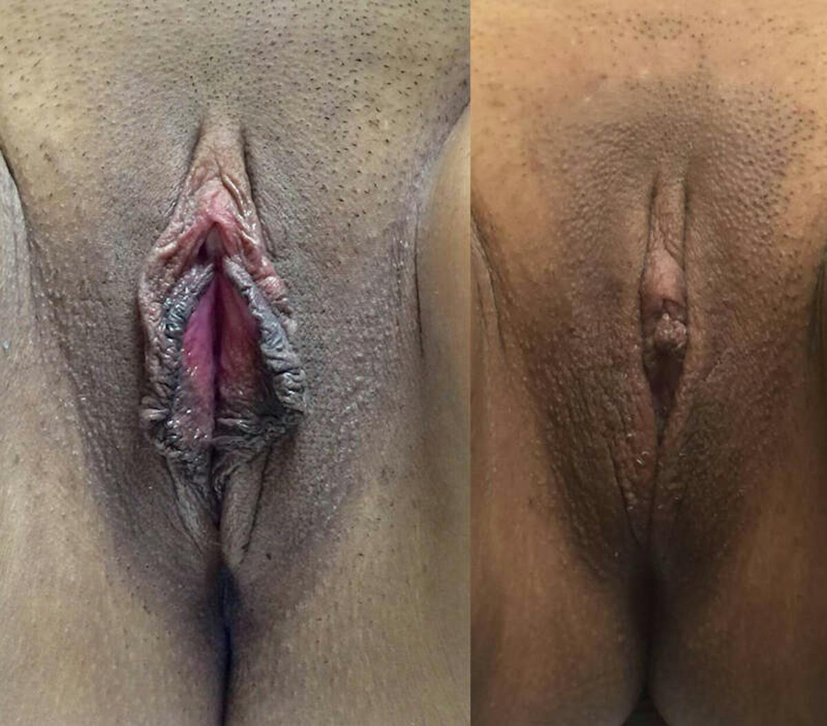 Labiaplasty Before & After Gallery - Patient 380174 - Image 1