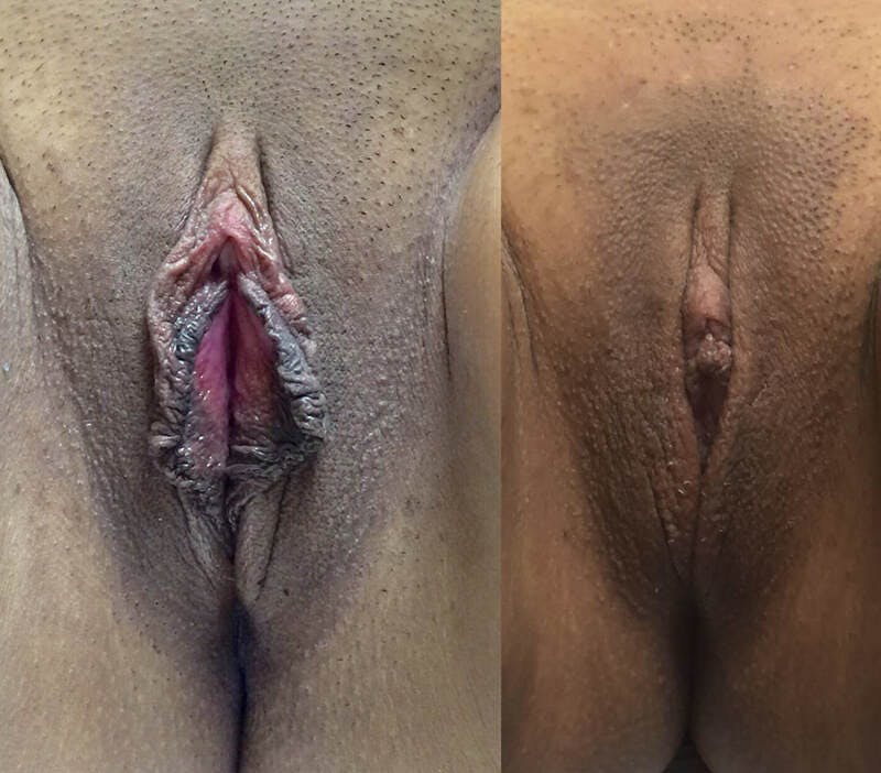 Labiaplasty Before & After Gallery - Patient 380174 - Image 1