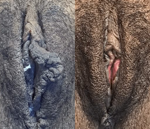 labiaplasty results