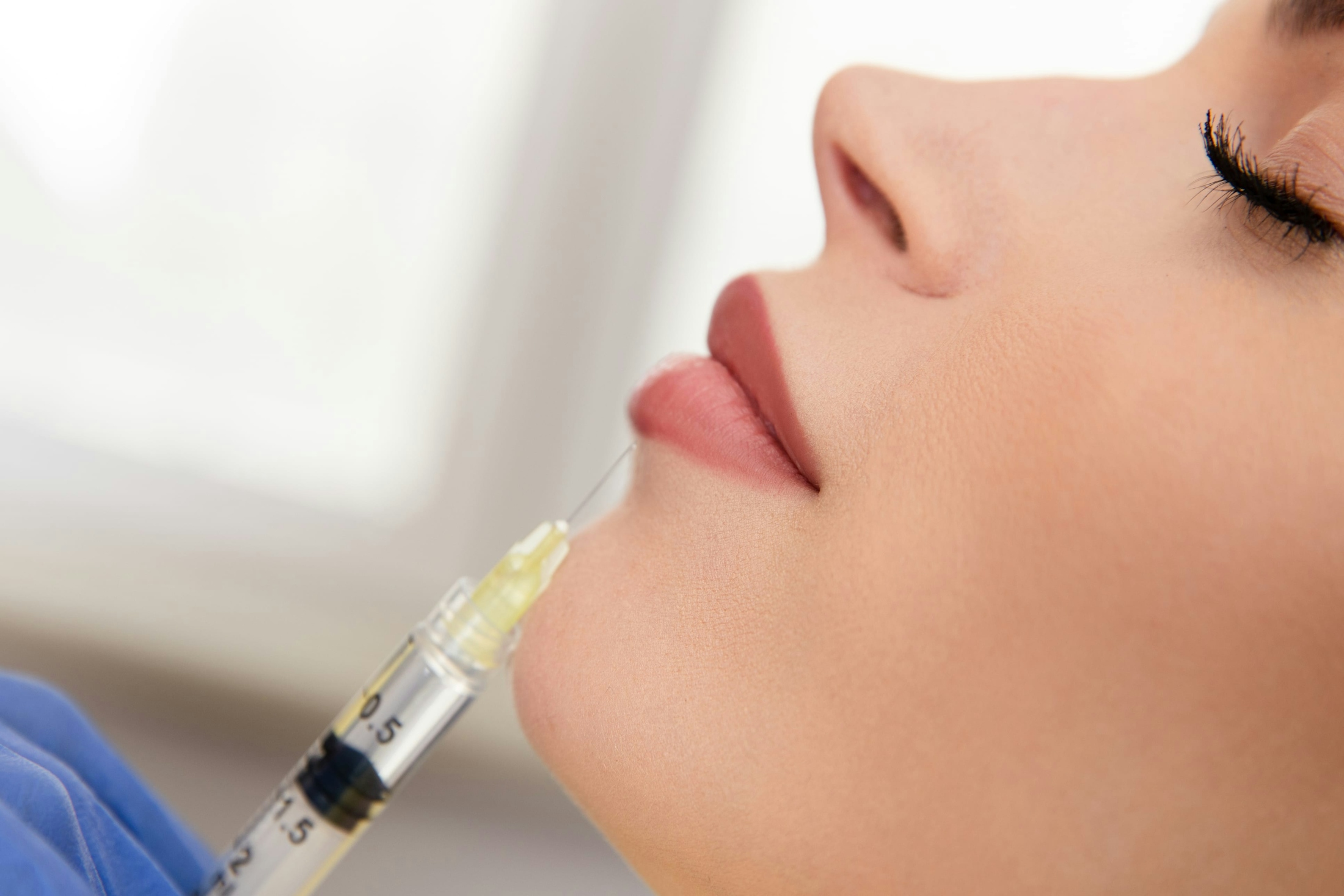 Woman receiving lip filler dissolver in Orlando