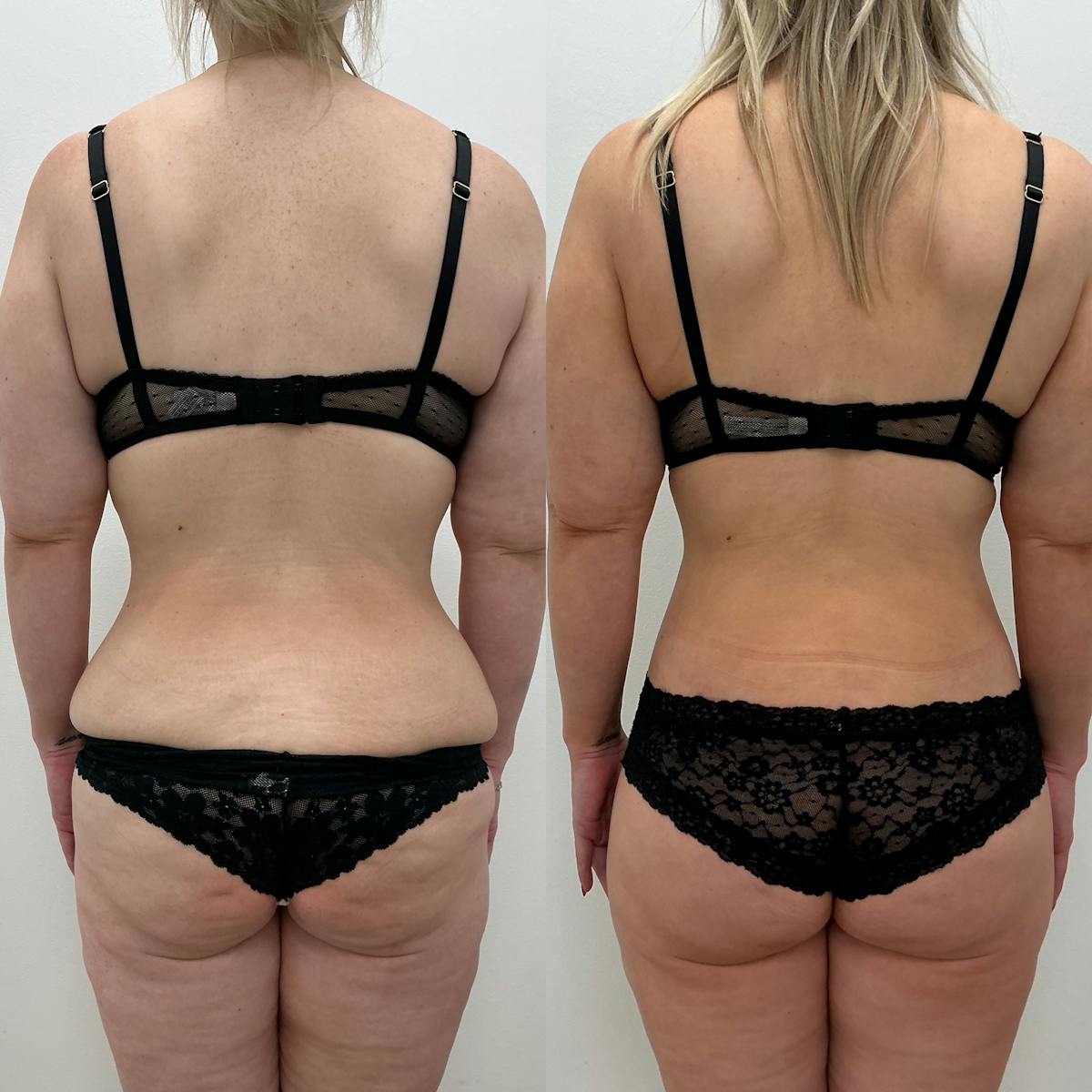 Lower Body Lift Before & After Gallery - Patient 253060 - Image 1