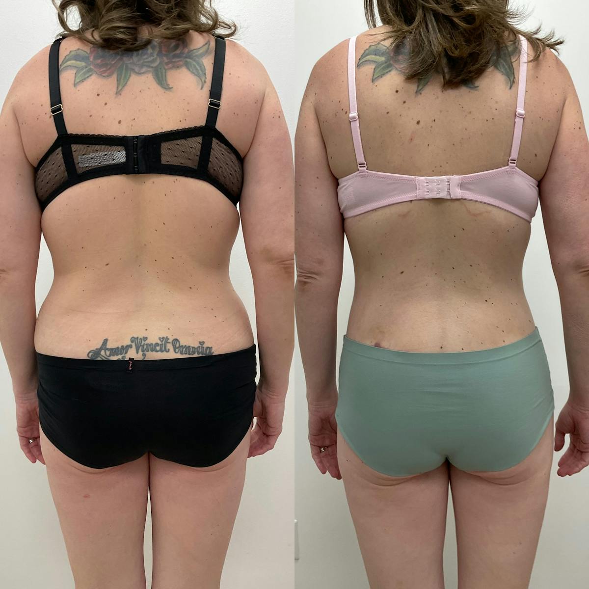 Lower Body Lift Before & After Gallery - Patient 136492 - Image 1