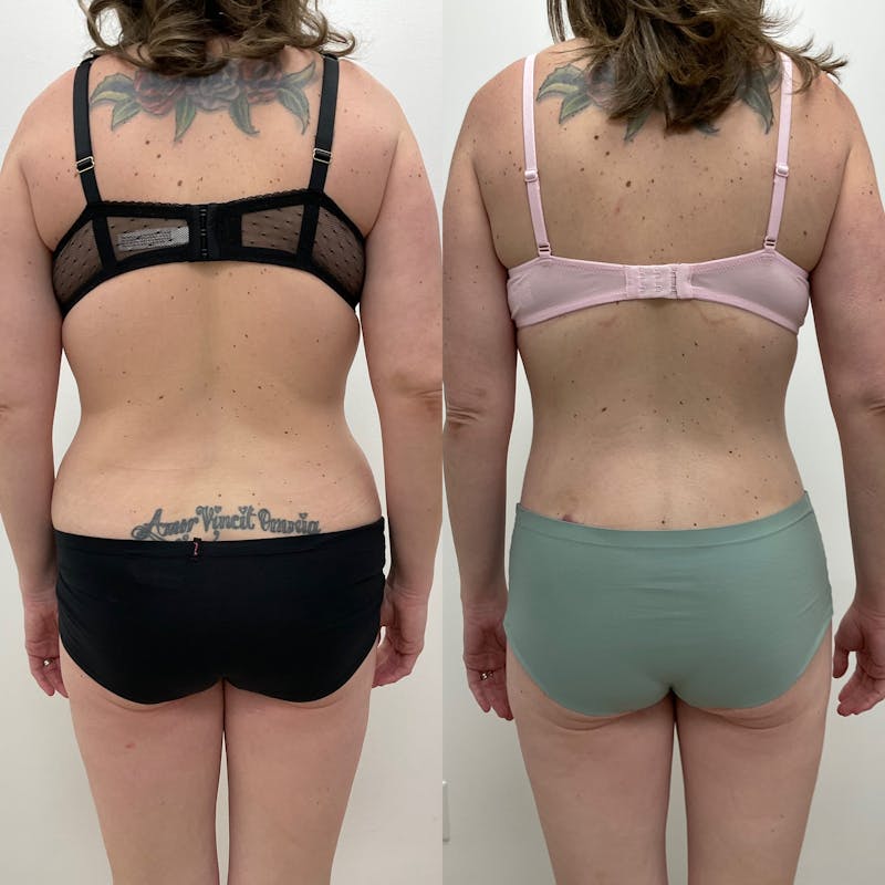 Lower Body Lift Before & After Gallery - Patient 136492 - Image 1