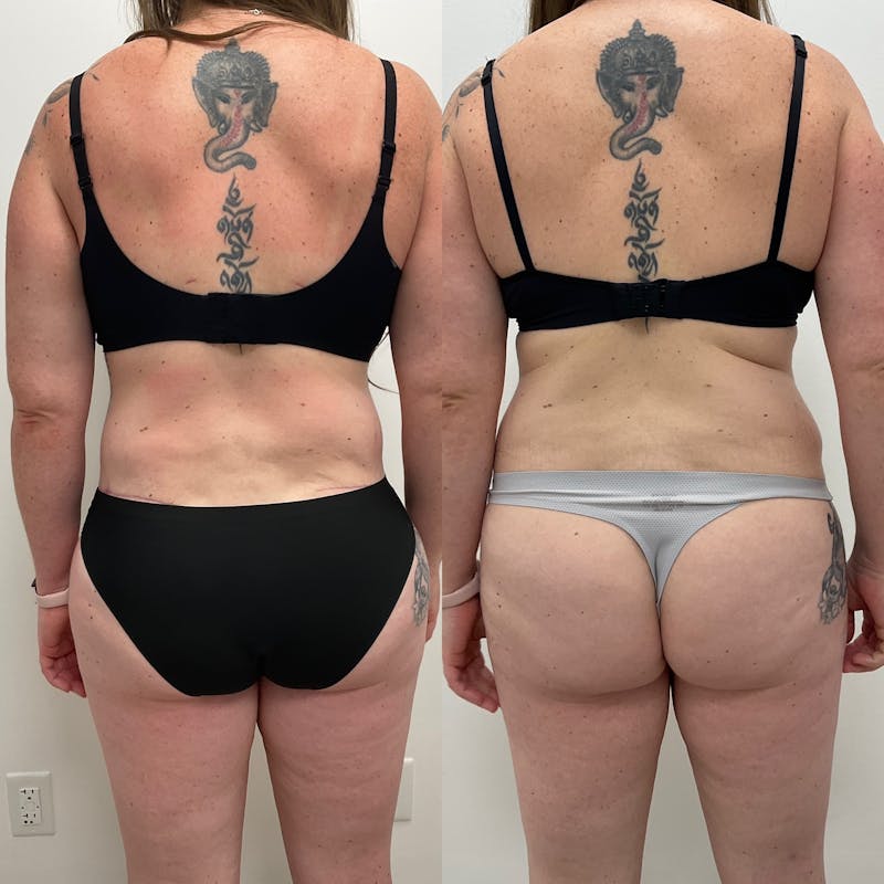 Lower Body Lift Before & After Gallery - Patient 318982 - Image 1