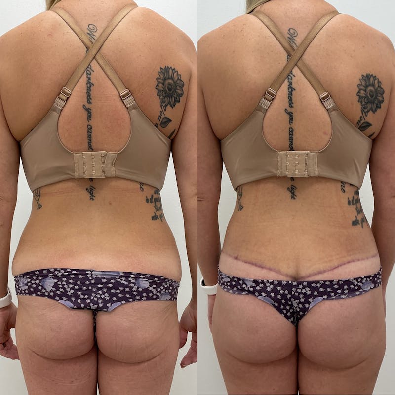 Lower Body Lift Before & After Gallery - Patient 325677 - Image 1