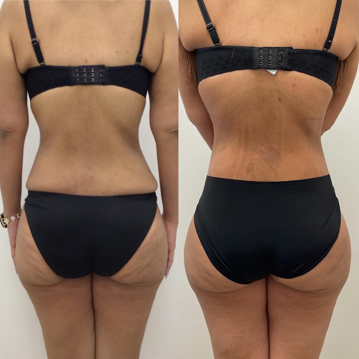 Lower Body Lift Before & After Gallery - Patient 702136 - Image 1