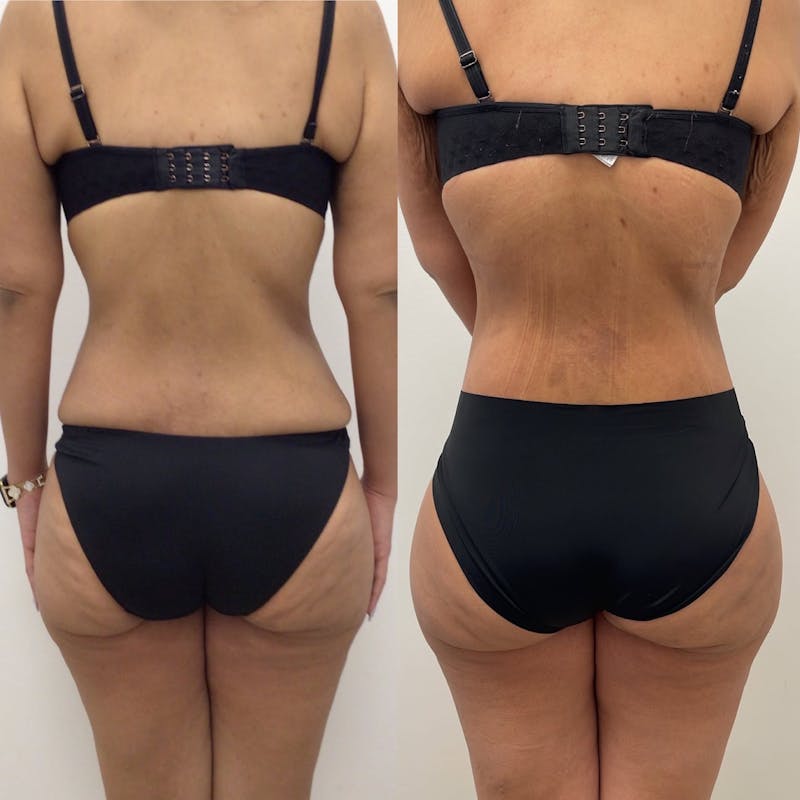 Lower Body Lift Before & After Gallery - Patient 702136 - Image 1