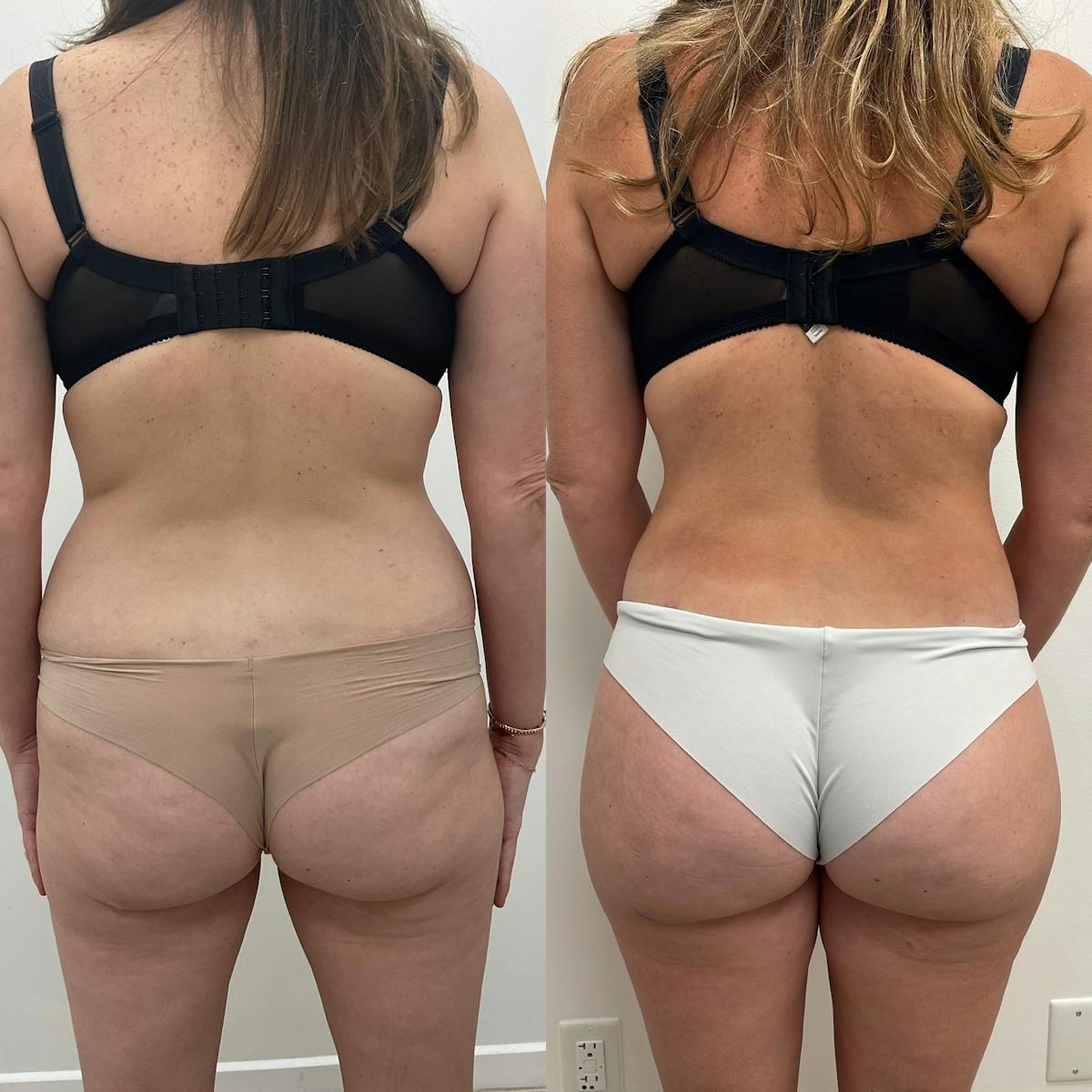 Lower Body Lift Before & After Gallery - Patient 125403 - Image 1