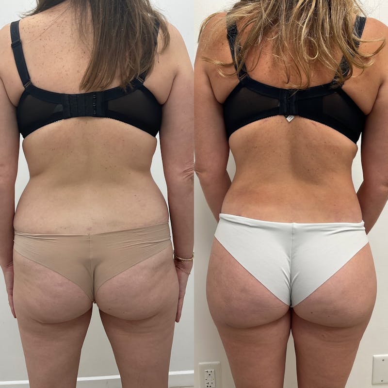 Lower Body Lift Before & After Gallery - Patient 125403 - Image 1