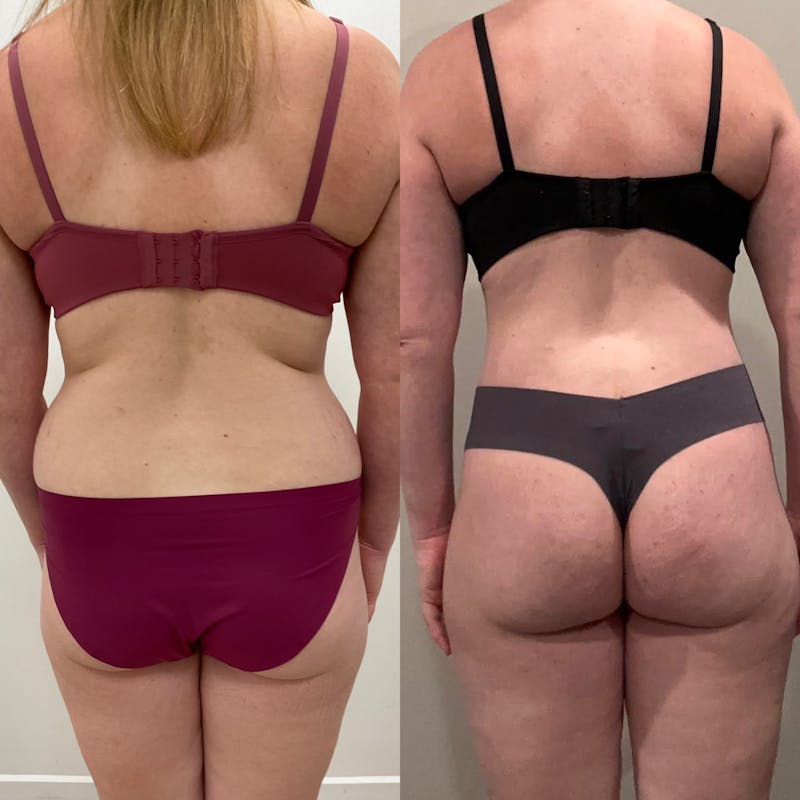 Lower Body Lift Before & After Gallery - Patient 334364 - Image 1