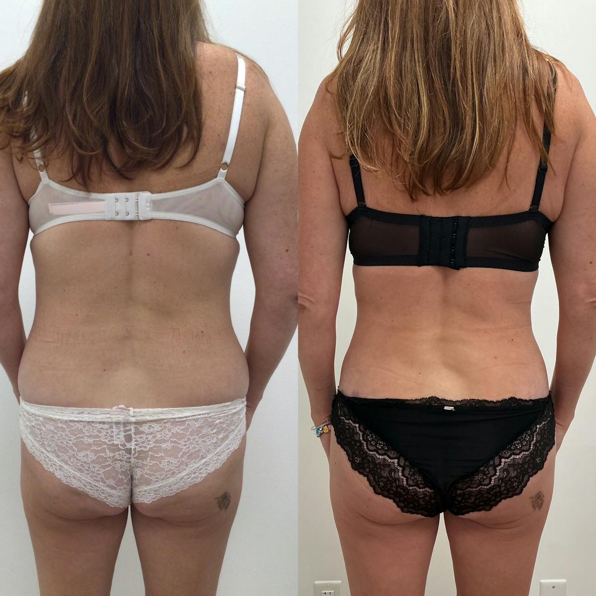 Lower Body Lift Before & After Gallery - Patient 428023 - Image 1
