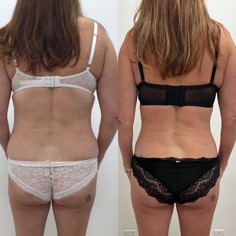 Lower Body Lift Before & After Gallery - Patient 428023 - Image 1