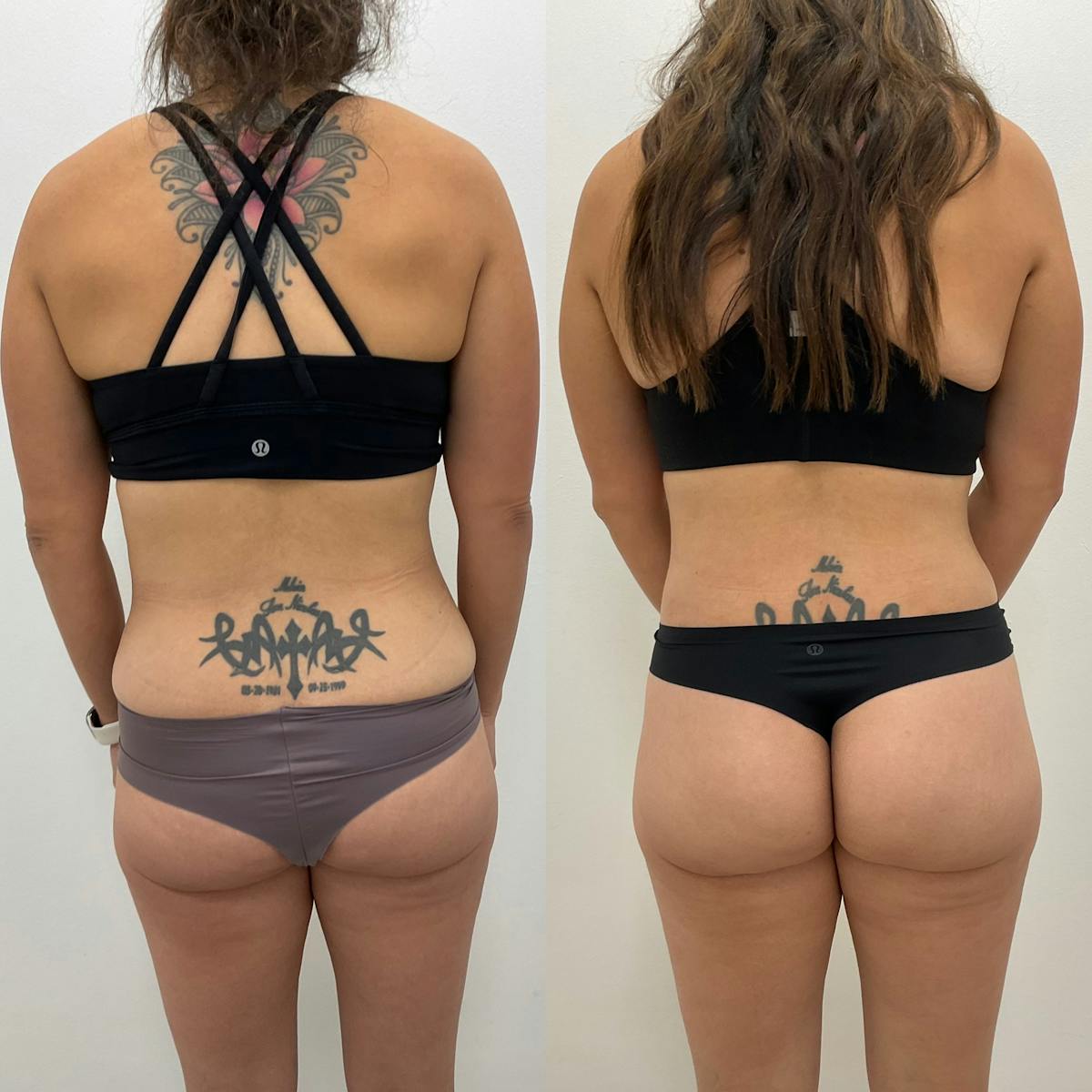Lower Body Lift Before & After Gallery - Patient 468009 - Image 1