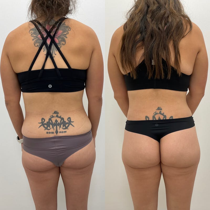 Lower Body Lift Before & After Gallery - Patient 468009 - Image 1