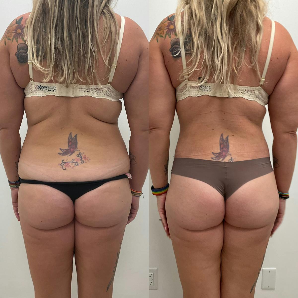 Lower Body Lift Before & After Gallery - Patient 892602 - Image 1