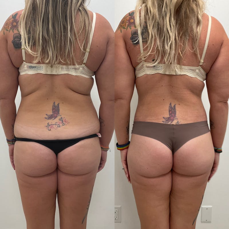 Lower Body Lift Before & After Gallery - Patient 892602 - Image 1