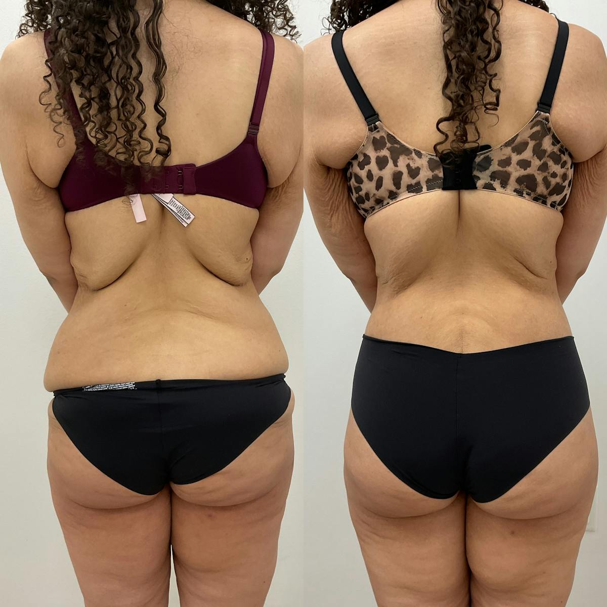 Lower Body Lift Before & After Gallery - Patient 140882 - Image 1