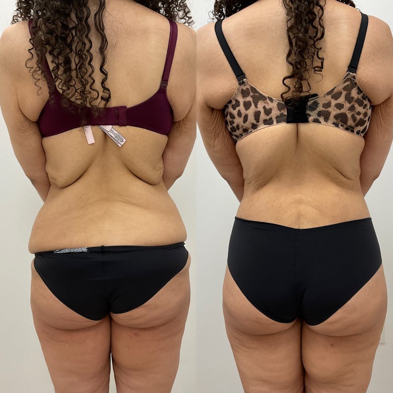 Lower Body Lift Before & After Gallery - Patient 140882 - Image 1