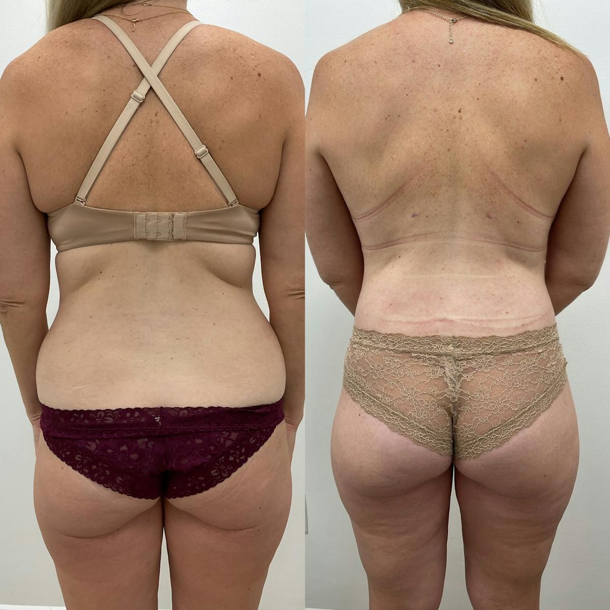 Lower Body Lift Before & After Gallery - Patient 495839 - Image 1