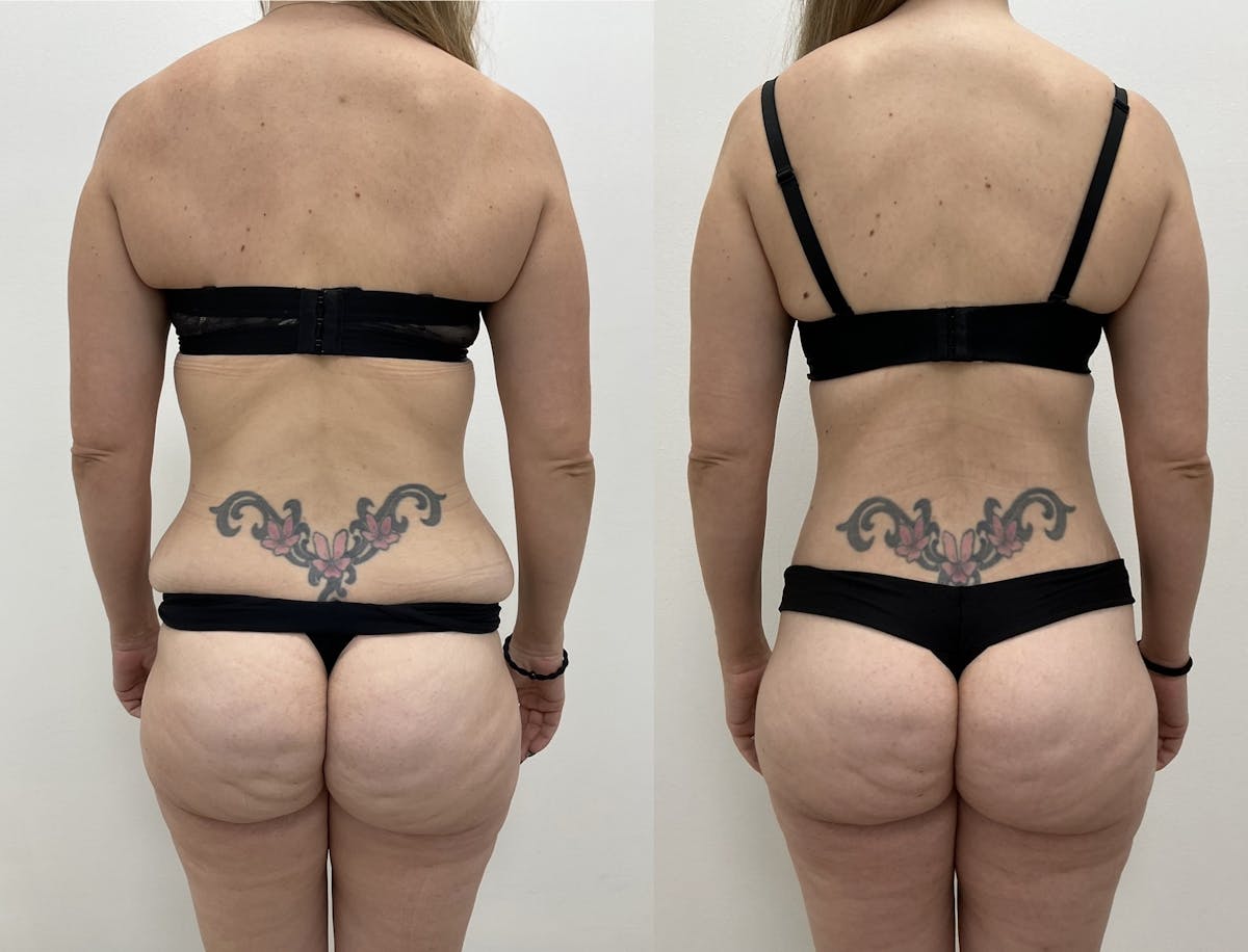 Lower Body Lift Before & After Gallery - Patient 383912 - Image 1