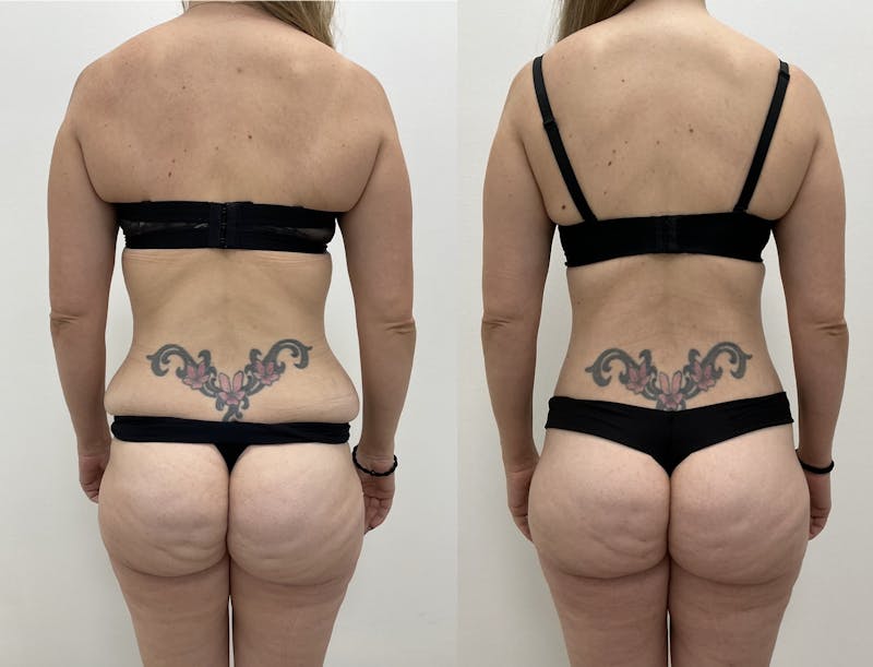 Lower Body Lift Before & After Gallery - Patient 383912 - Image 1