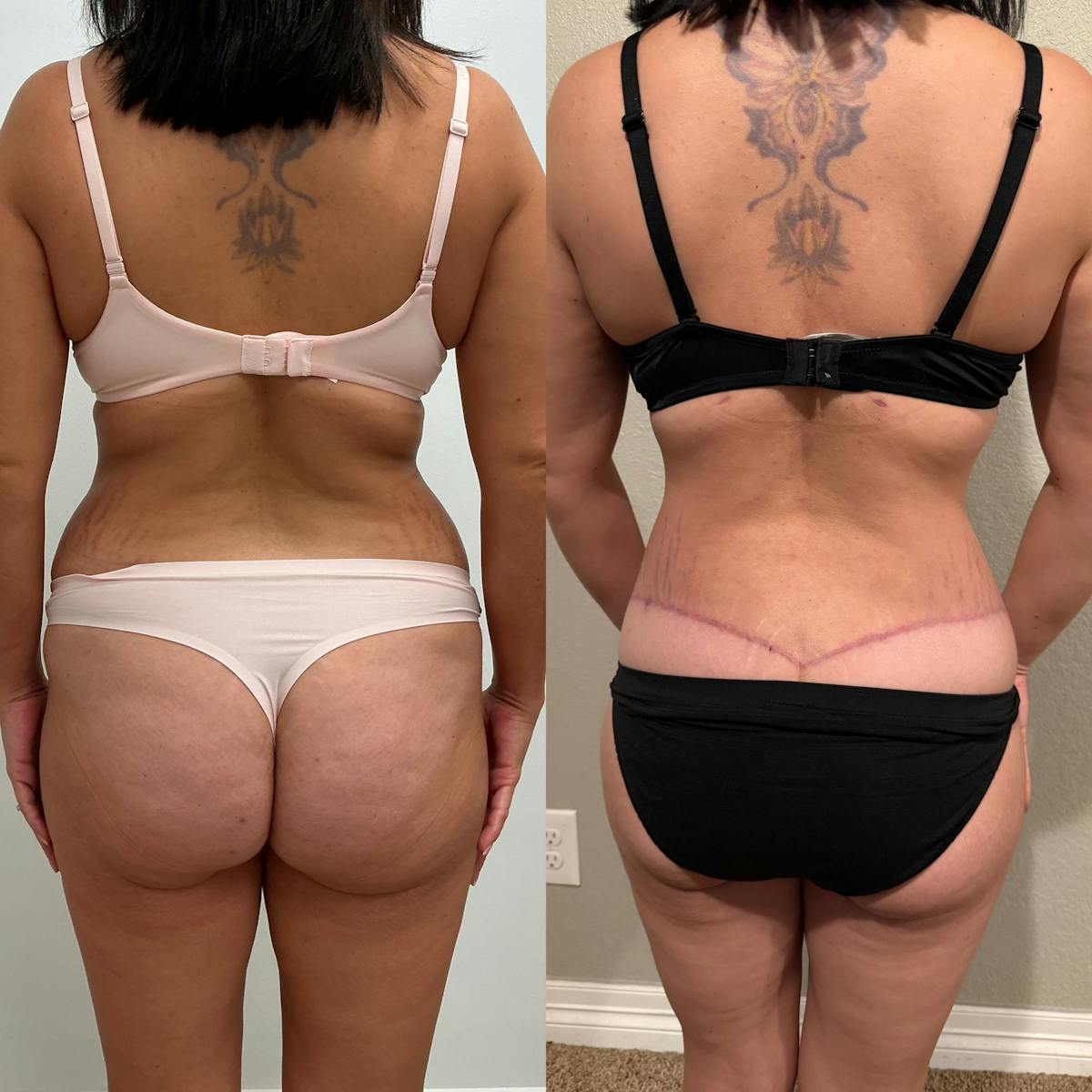 Lower Body Lift Before & After Gallery - Patient 111133 - Image 1