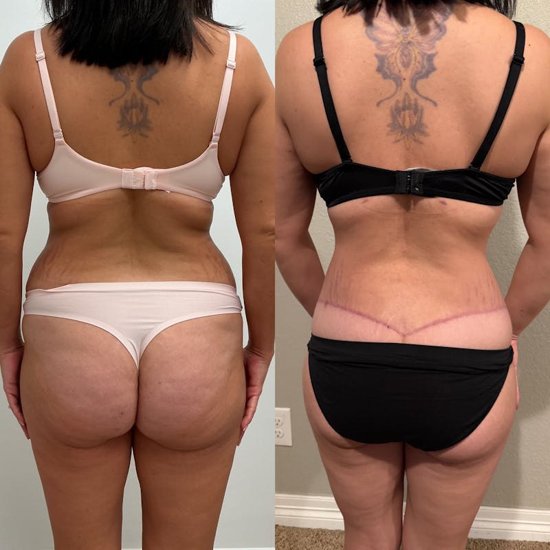 Lower Body Lift Before & After Gallery - Patient 111133 - Image 1