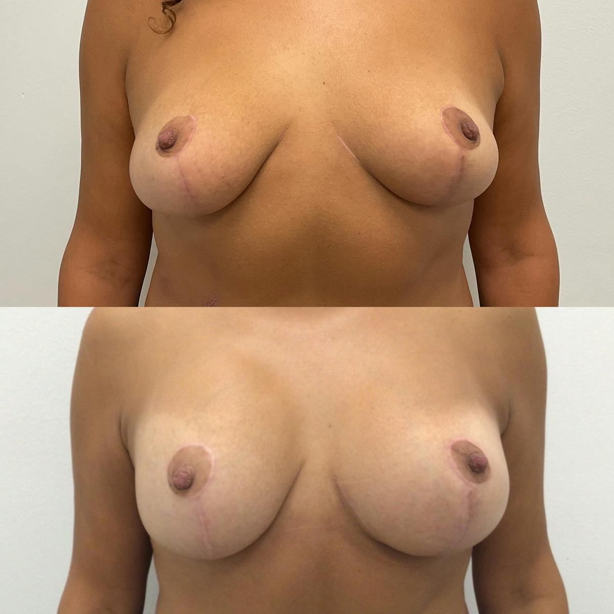 Breast Lift With Implants Before & After Gallery - Patient 725337 - Image 1