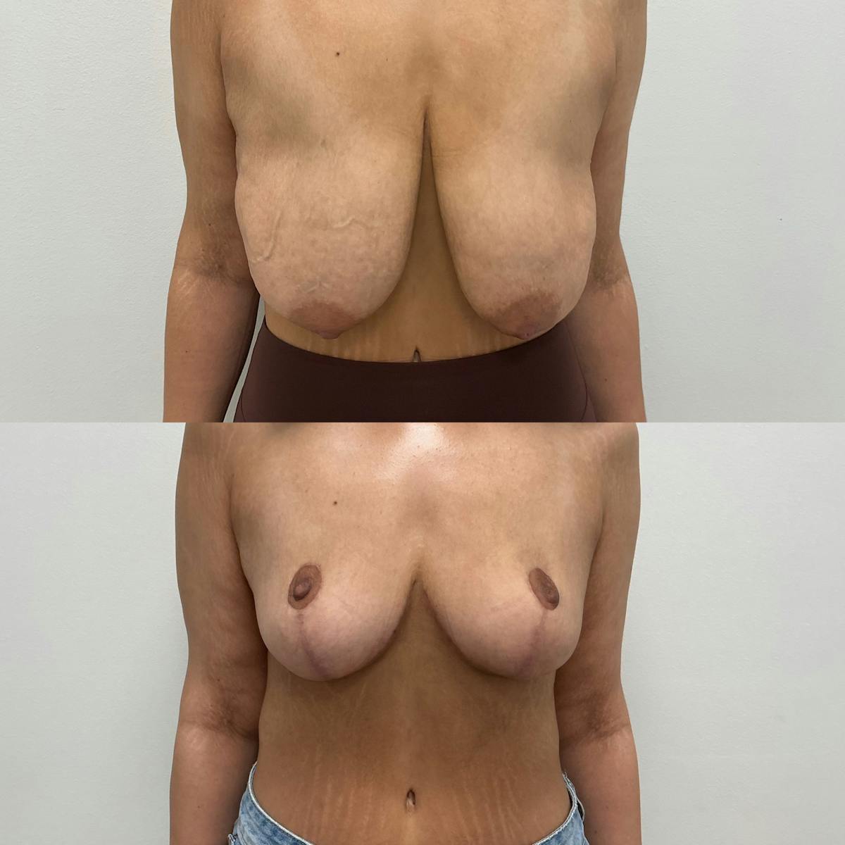 Breast Reduction Before & After Gallery - Patient 367810 - Image 1