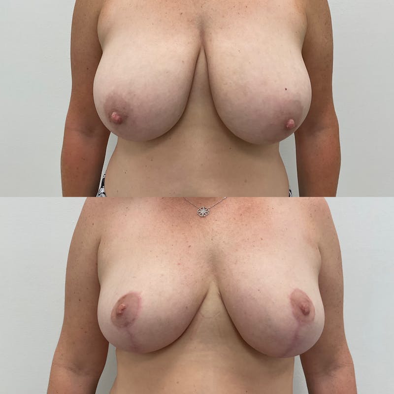 Breast Reduction Before & After Gallery - Patient 201675 - Image 1