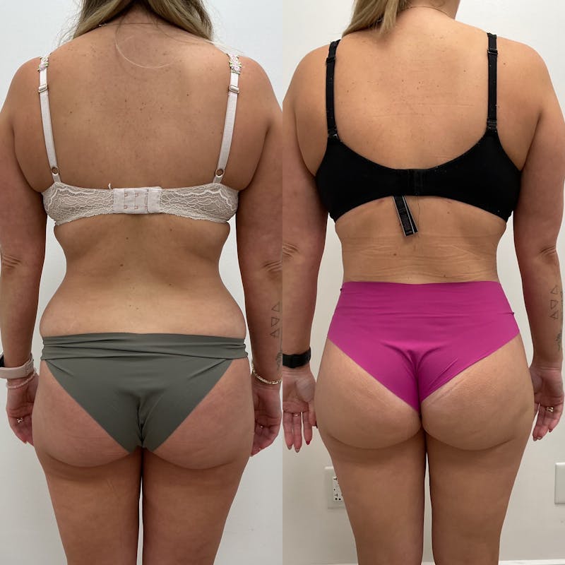 Flankplasty Before & After Gallery - Patient 177029 - Image 1