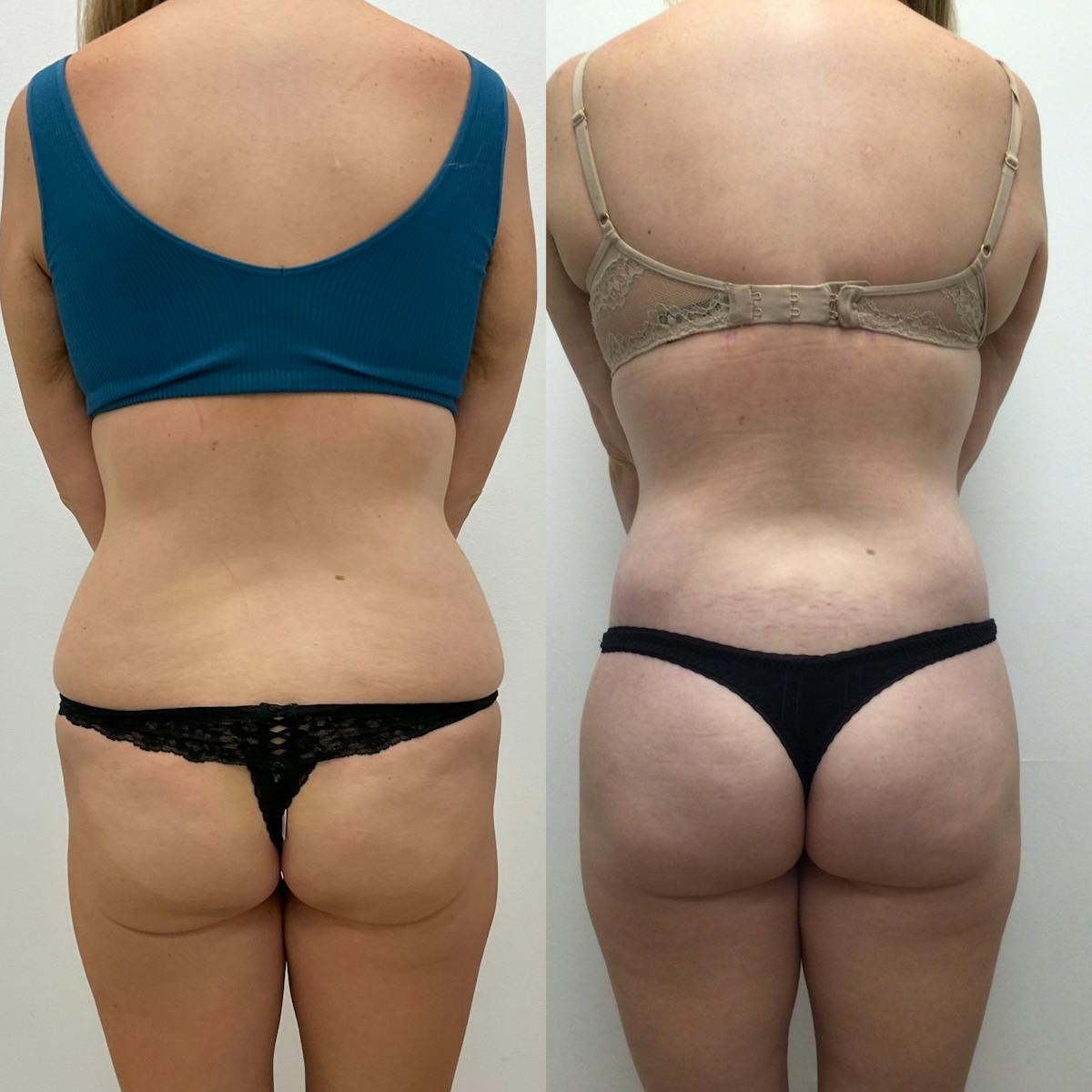 Flankplasty Before & After Gallery - Patient 342252 - Image 1