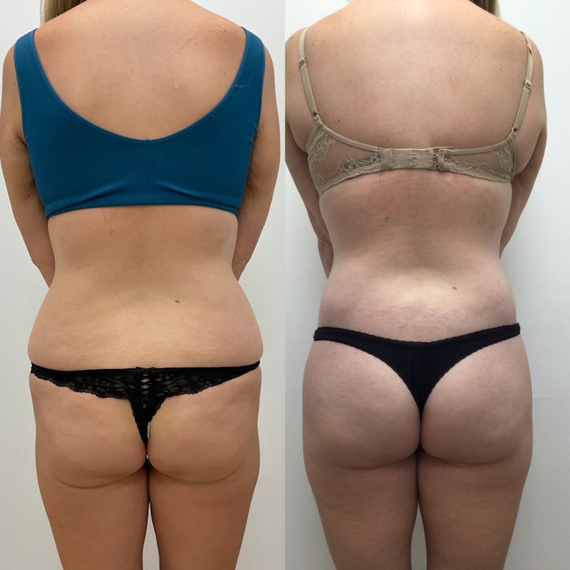 Flankplasty Before & After Gallery - Patient 342252 - Image 1