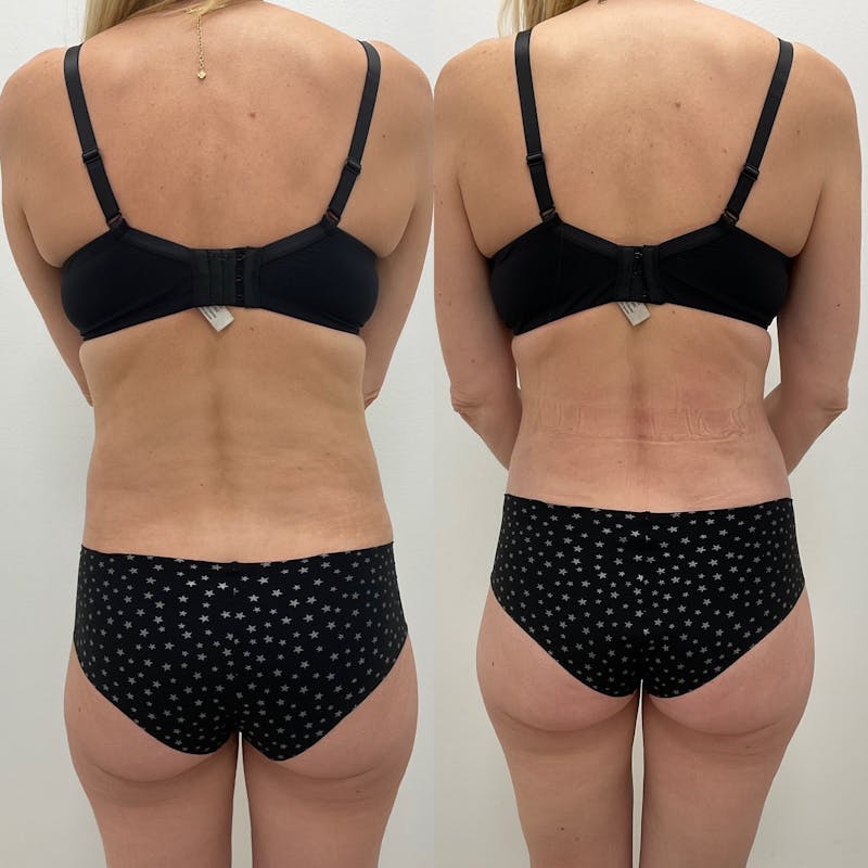 Flankplasty Before & After Gallery - Patient 733325 - Image 1