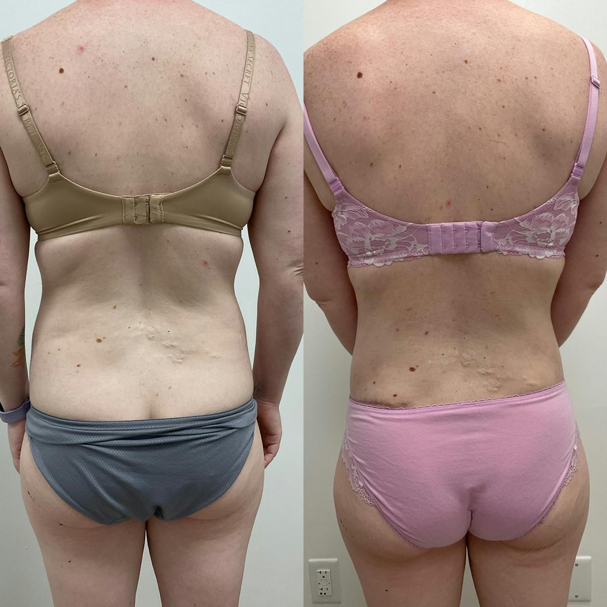 Flankplasty Before & After Gallery - Patient 149781 - Image 1