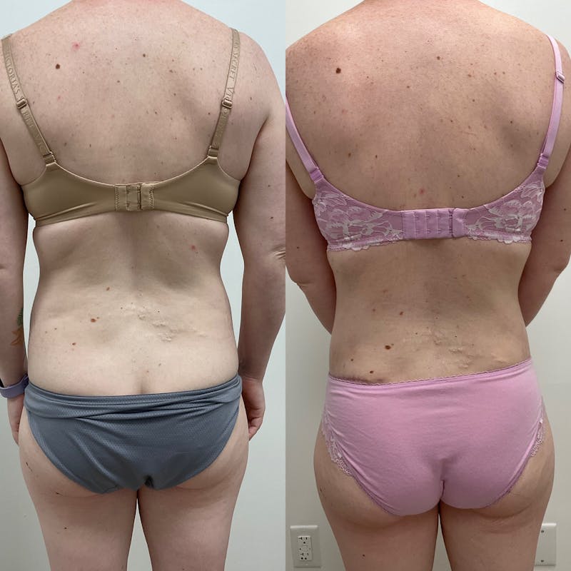 Flankplasty Before & After Gallery - Patient 149781 - Image 1