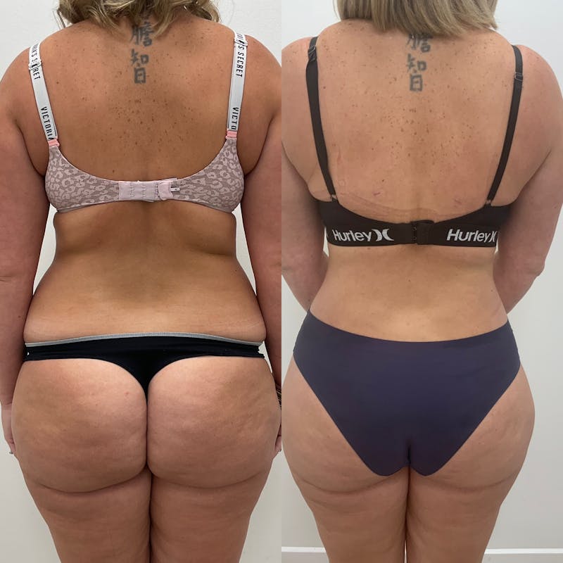 Flankplasty Before & After Gallery - Patient 127597 - Image 1