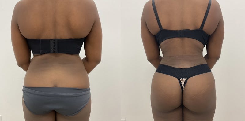 Flankplasty Before & After Gallery - Patient 419895 - Image 1