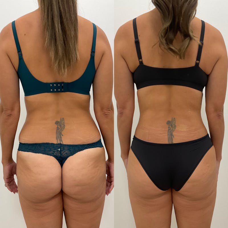 Flankplasty Before & After Gallery - Patient 208872 - Image 1