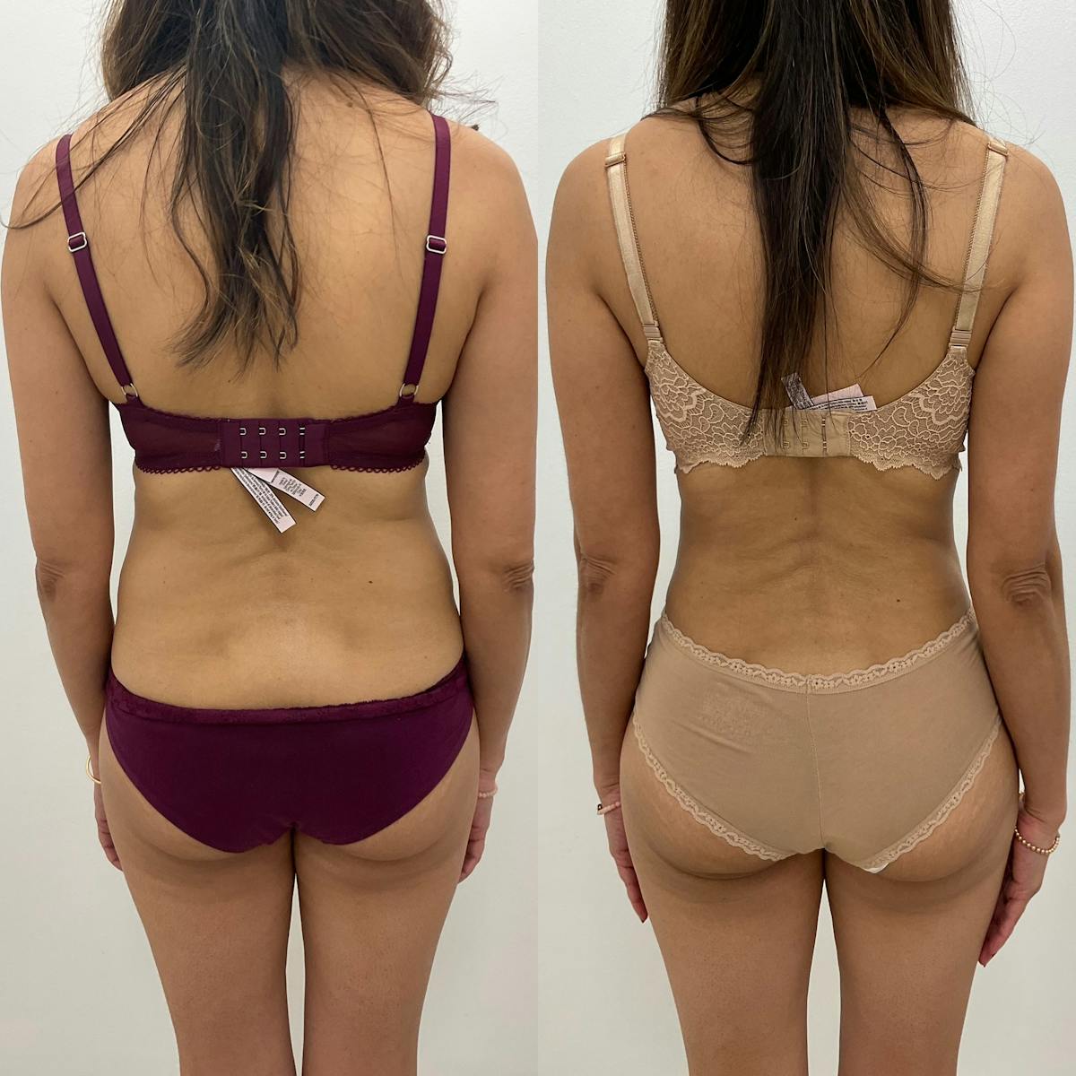 Flankplasty Before & After Gallery - Patient 400702 - Image 1