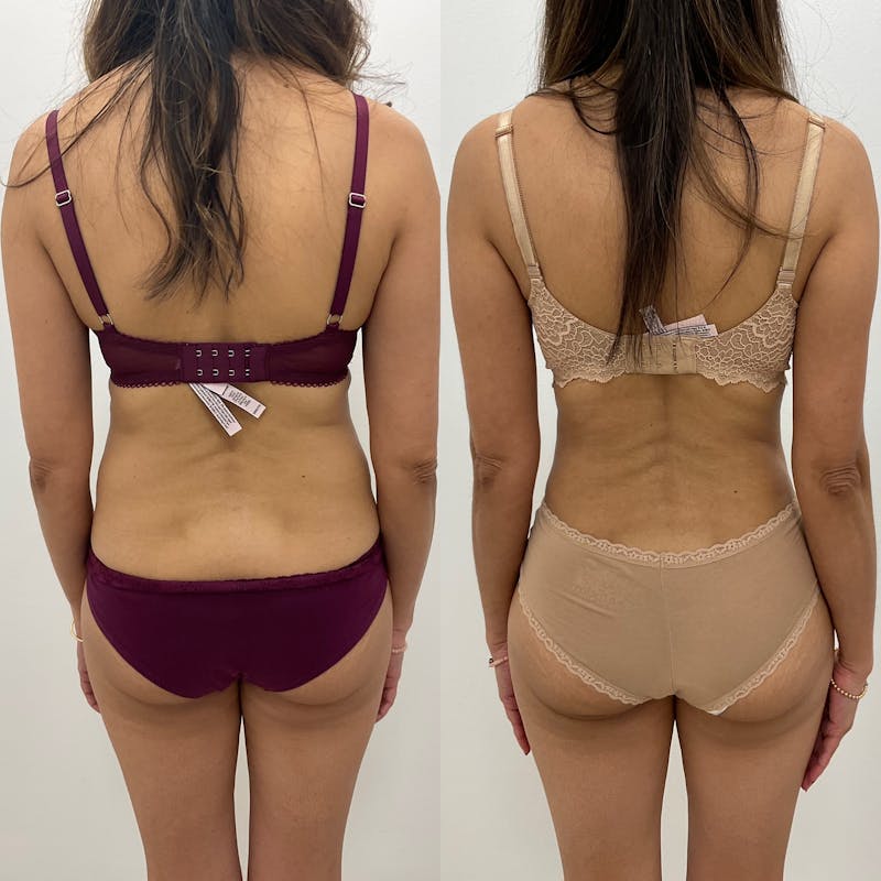 Flankplasty Before & After Gallery - Patient 400702 - Image 1