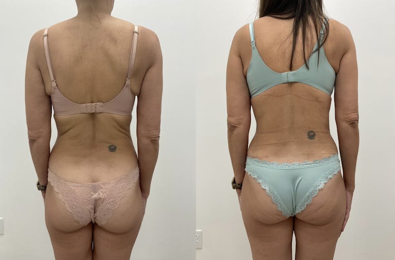 Flankplasty Before & After Gallery - Patient 190389 - Image 1