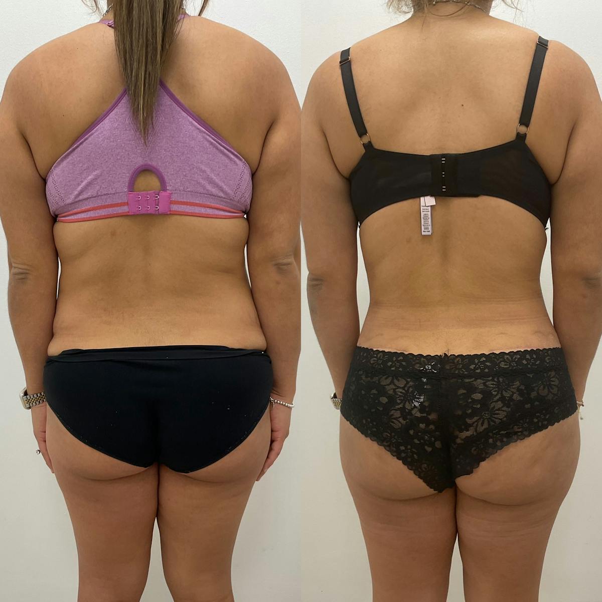 Flankplasty Before & After Gallery - Patient 247991 - Image 1