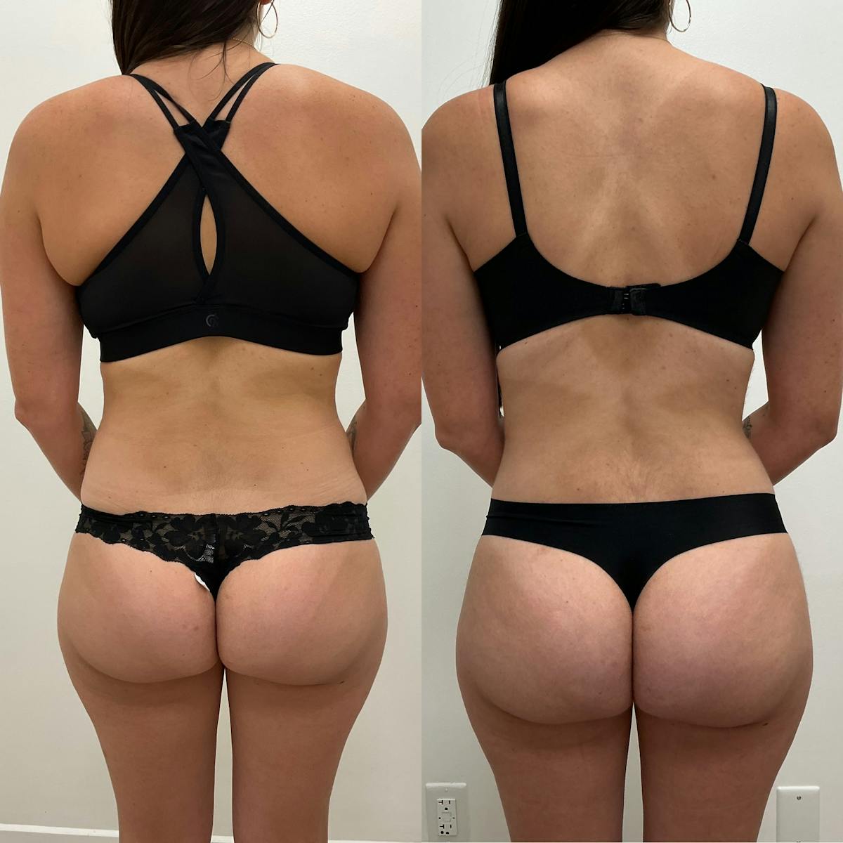 Flankplasty Before & After Gallery - Patient 828495 - Image 1