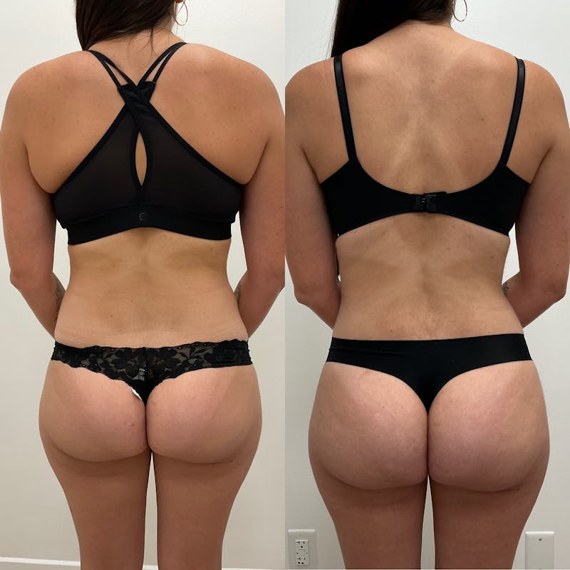 Flankplasty Before & After Gallery - Patient 828495 - Image 1