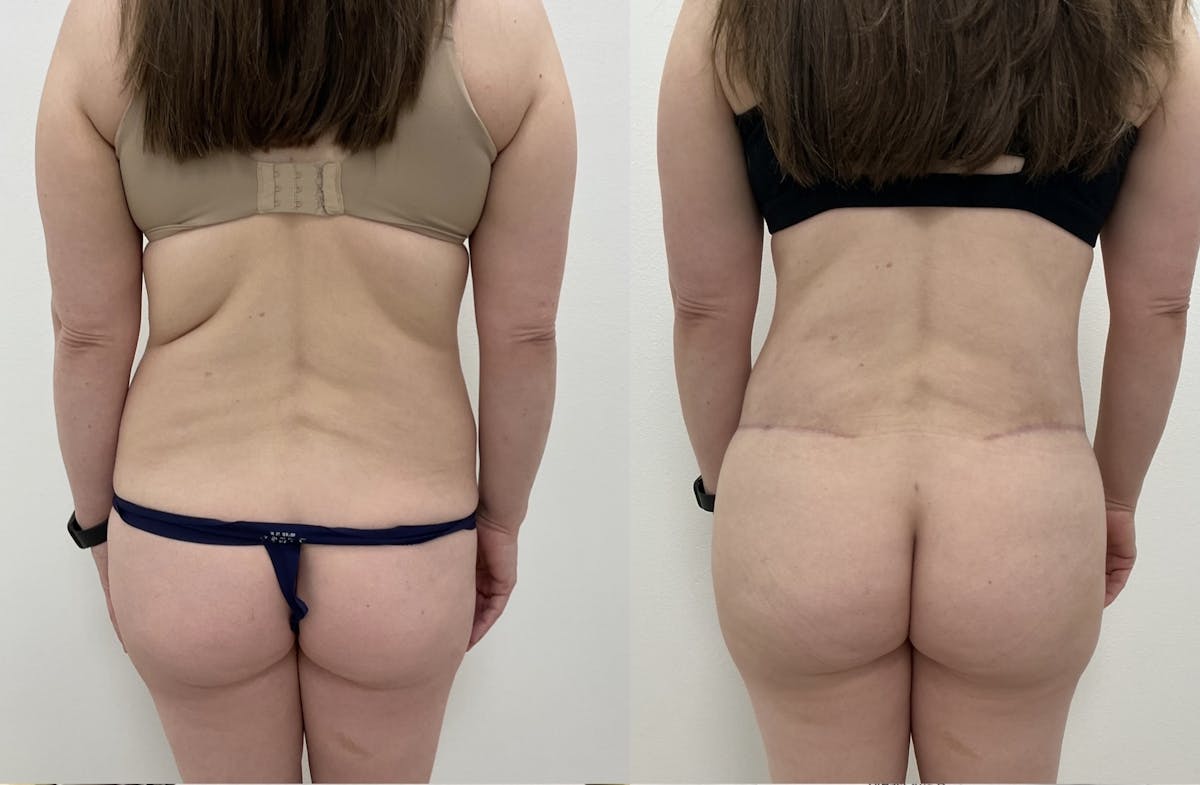 Flankplasty Before & After Gallery - Patient 753586 - Image 1